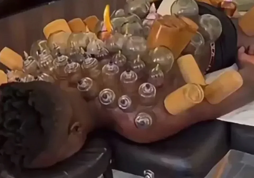 André Onana Shares Cupping Therapy Recovery Routine at Trabzonspor